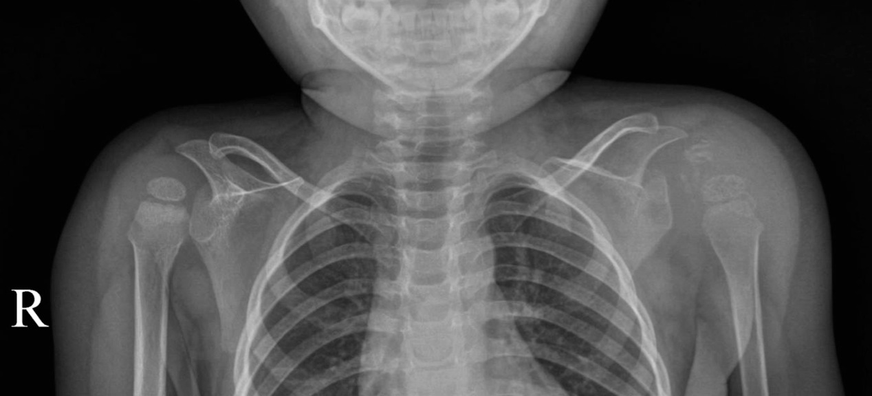 Figure 2 for case Myositis ossificans